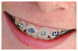 ortodoncia-correctora-infantil