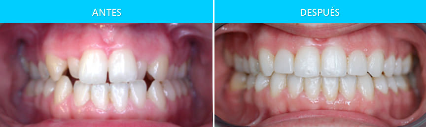 ortodoncia sin cirugía en adulto