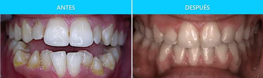 ortodoncia adulto con mordida abierta. tratamiento sólo con brackets